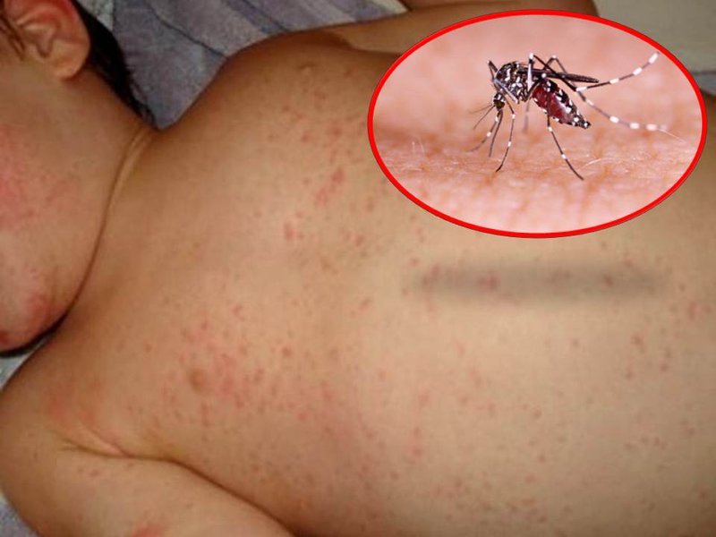 Ảnh 2 của Dengue hemorrhagic fever